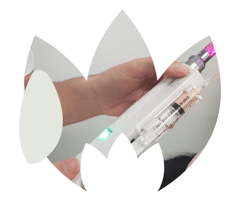 Dermapen Microneedling